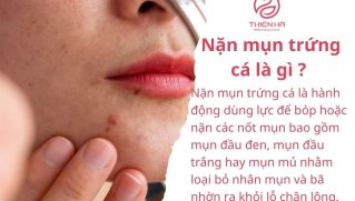 Nặn mụn trứng cá có nên không? Khi nào nặn an toàn cho da ?