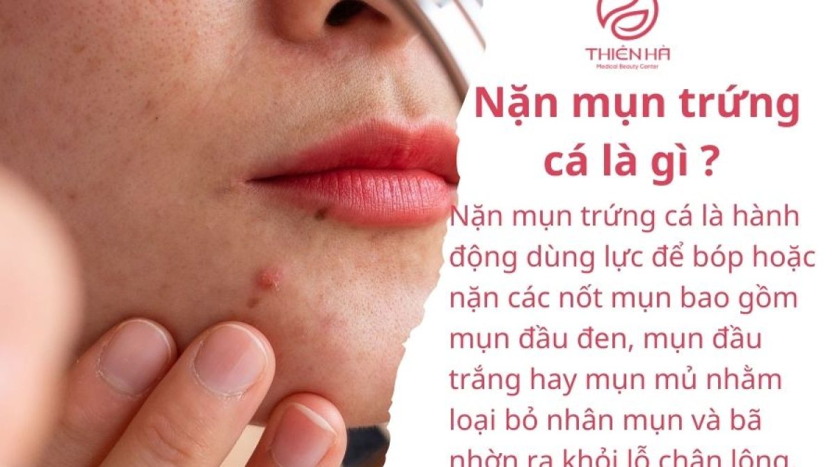 Nặn mụn trứng cá có nên không? Khi nào nặn an toàn cho da ?