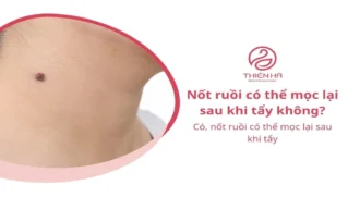 Nguyên nhân nốt ruồi mọc lại sau khi tẩy và cách xử lý an toàn
