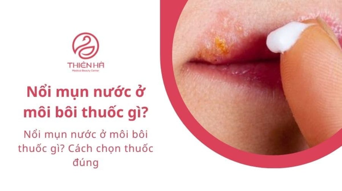 Nổi mụn nước ở môi bôi thuốc gì? Cách chọn thuốc đúng