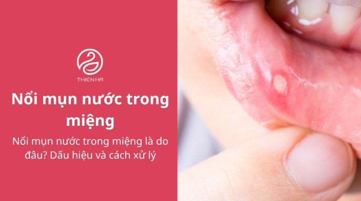 Nổi mụn nước trong miệng: Nguyên nhân, dấu hiệu và cách xử lý