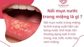 Nổi mụn nước trong miệng là do đâu ? Khi nào cần đi khám ?