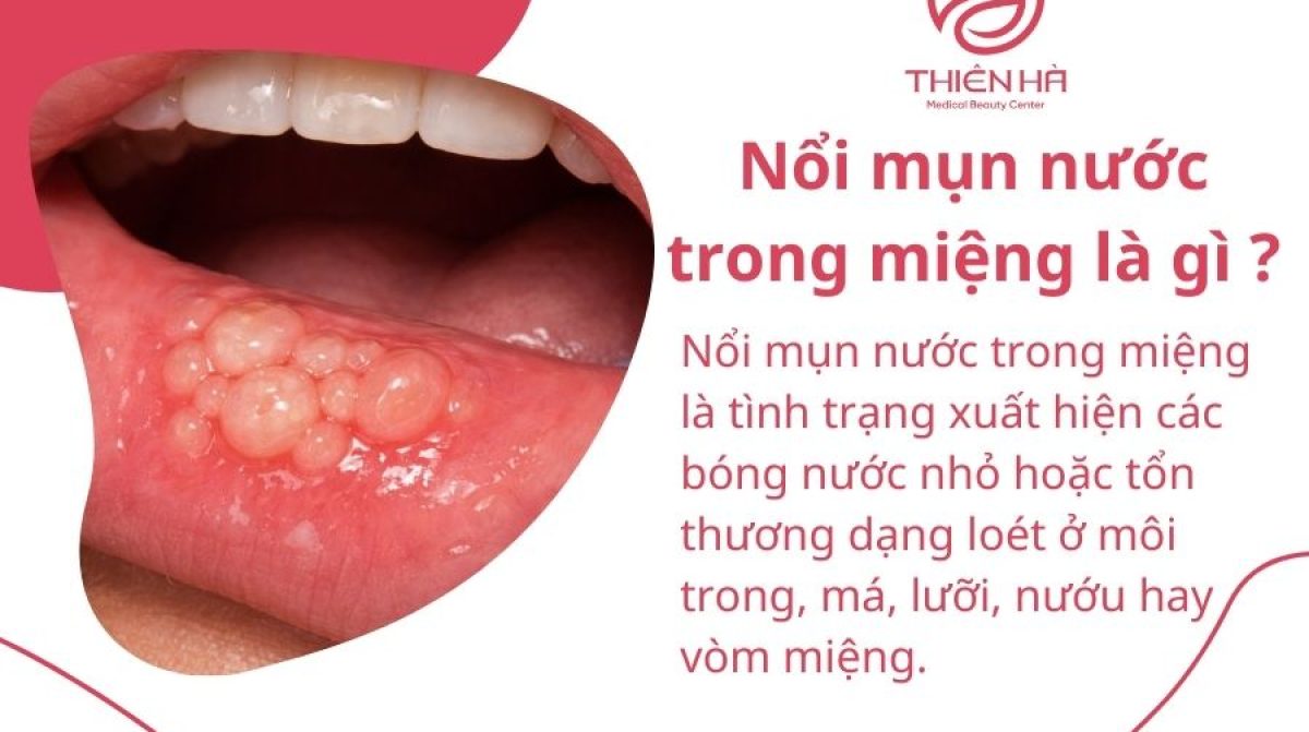 Nổi mụn nước trong miệng là do đâu ? Khi nào cần đi khám ?