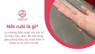 Nốt ruồi là gì? Nguyên nhân, đặc điểm và cách xử lý an toàn