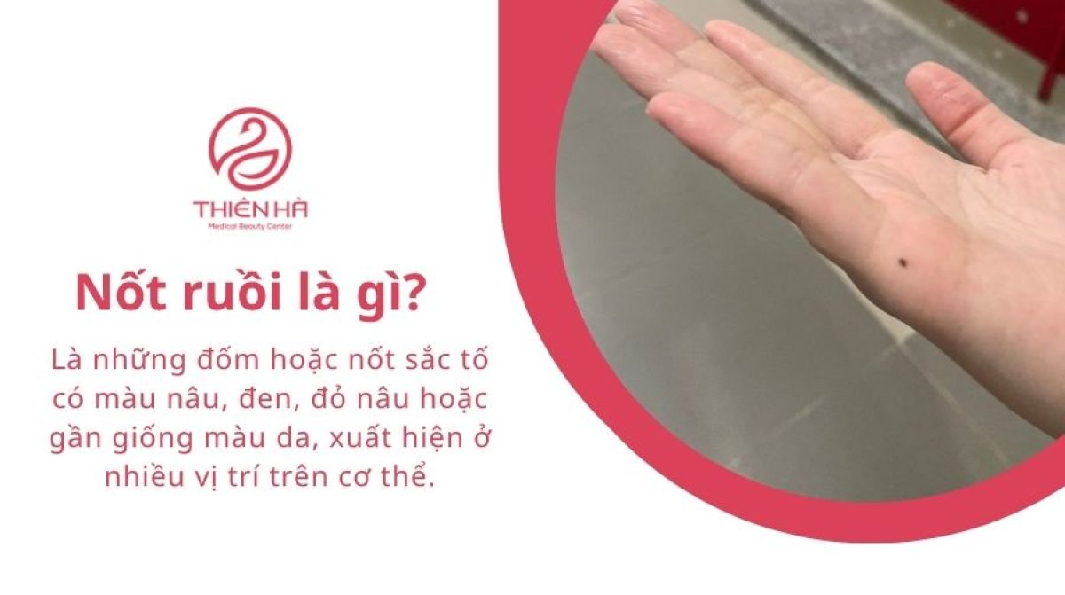 Nốt ruồi là gì? Nguyên nhân, đặc điểm và cách xử lý an toàn