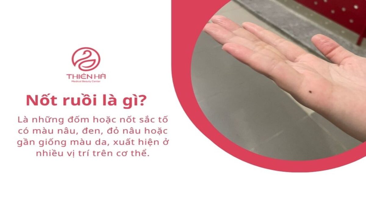Nốt ruồi là gì? Nguyên nhân, đặc điểm và cách xử lý an toàn