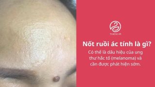 Nốt ruồi ác tính: Dấu hiệu nhận biết, nguy hiểm và cách xử lý