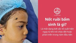 Nốt ruồi bẩm sinh là gì? Đặc điểm, phân loại và cách xử lý