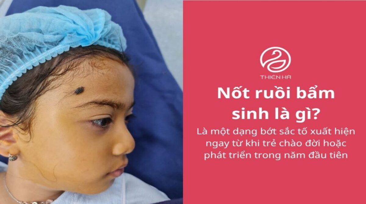 Nốt ruồi bẩm sinh là gì? Đặc điểm, phân loại và cách xử lý