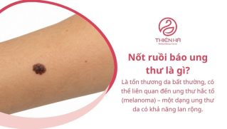 Nốt ruồi báo ung thư: Dấu hiệu nhận biết và khi nào cần khám