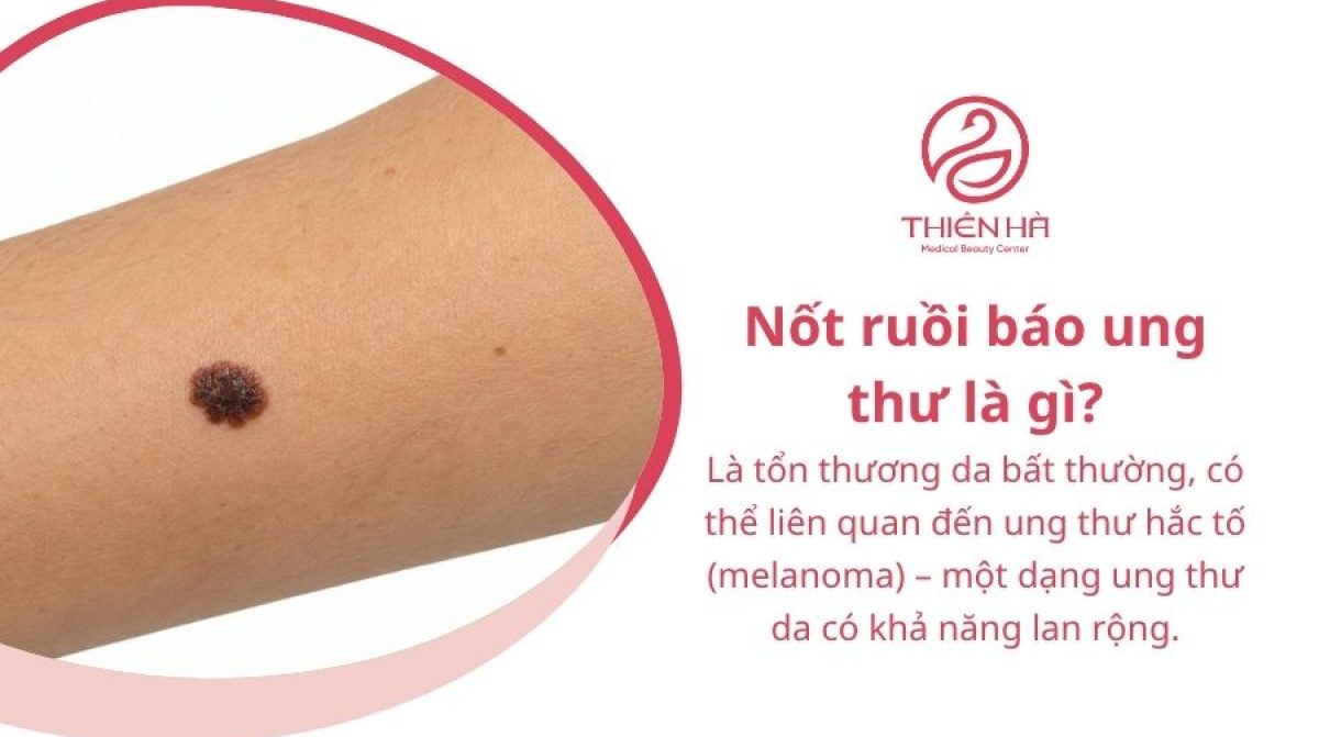 Nốt ruồi báo ung thư: Dấu hiệu nhận biết và khi nào cần khám
