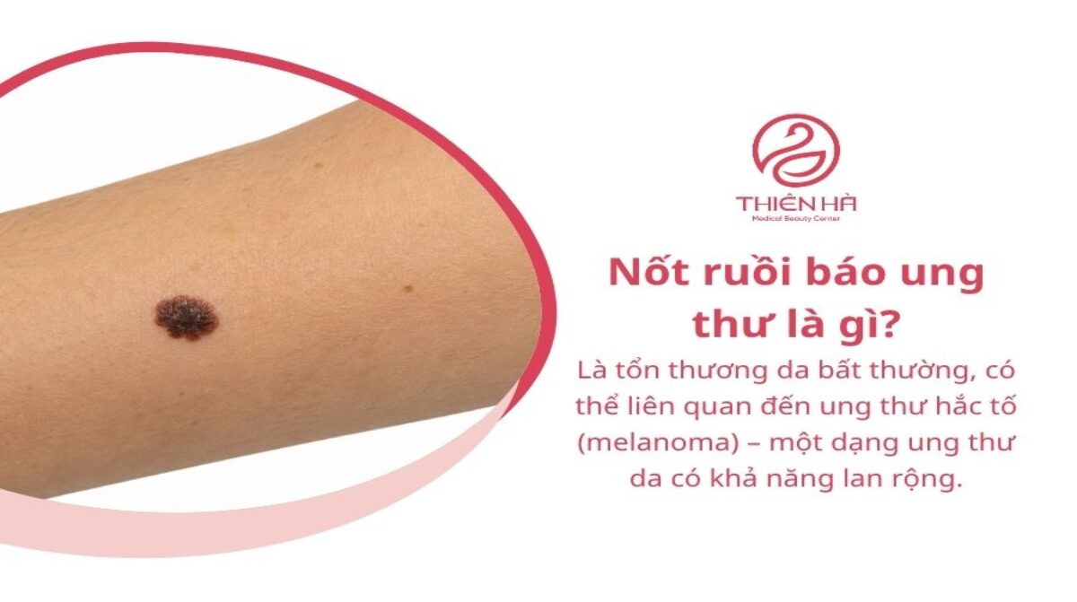 Nốt ruồi báo ung thư: Dấu hiệu nhận biết và khi nào cần khám