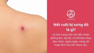 Nốt ruồi bị sưng đỏ: Vì sao xảy ra và khi nào cần đi khám?