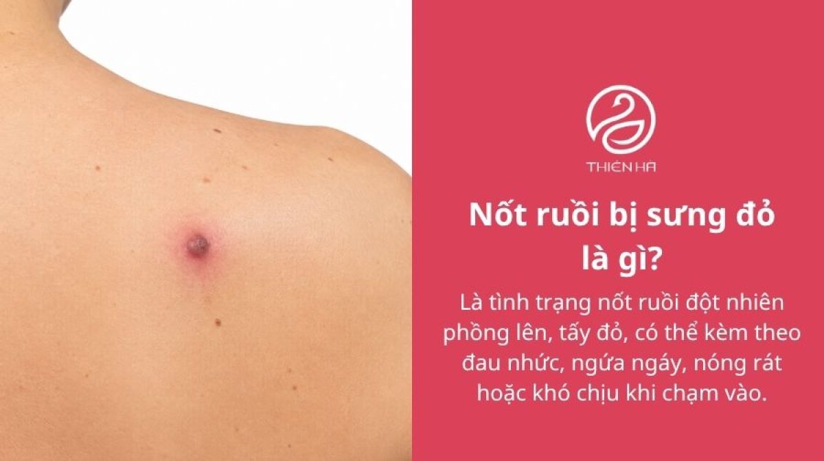 Nốt ruồi bị sưng đỏ: Vì sao xảy ra và khi nào cần đi khám?
