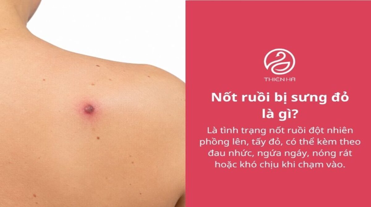 Nốt ruồi bị sưng đỏ: Vì sao xảy ra và khi nào cần đi khám?