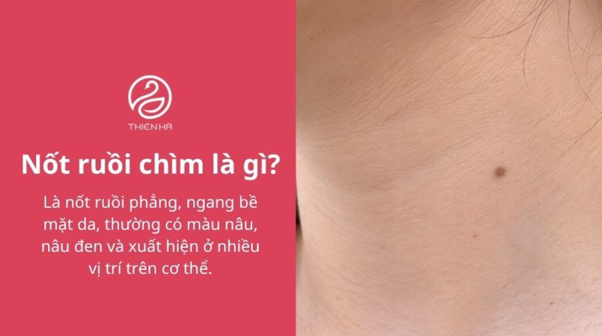 Nốt ruồi chìm là gì? Có nguy hiểm không và có nên tẩy?
