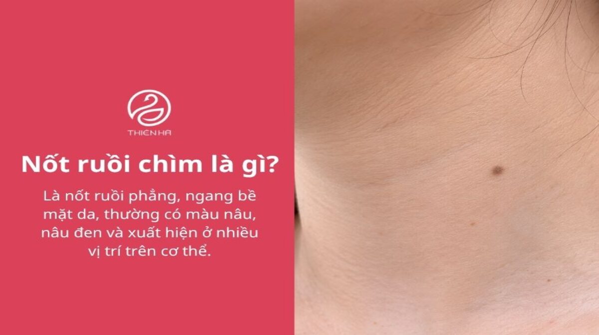 Nốt ruồi chìm là gì? Có nguy hiểm không và có nên tẩy?