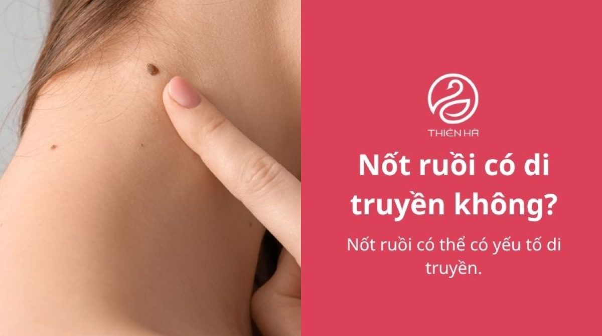 Nốt ruồi có di truyền không? Nguyên nhân và điều cần biết