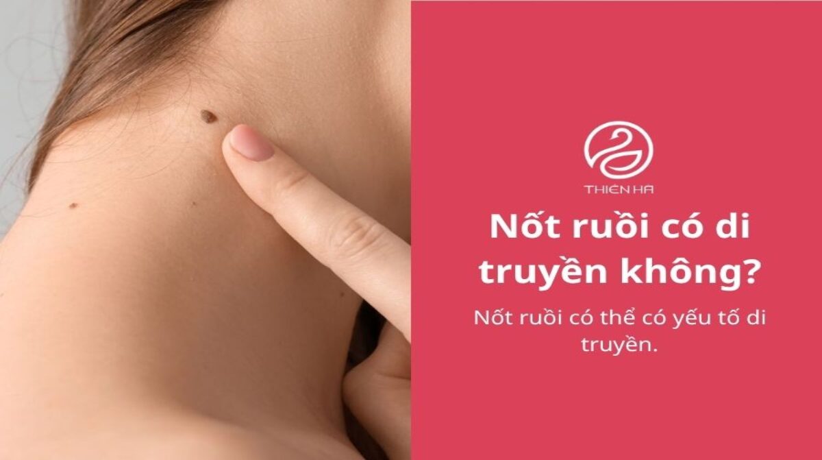 Nốt ruồi có di truyền không? Nguyên nhân và điều cần biết