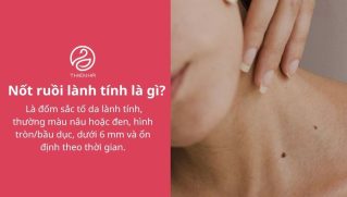 Nốt ruồi lành tính: Phân biệt với ác tính và cách xử lý đúng
