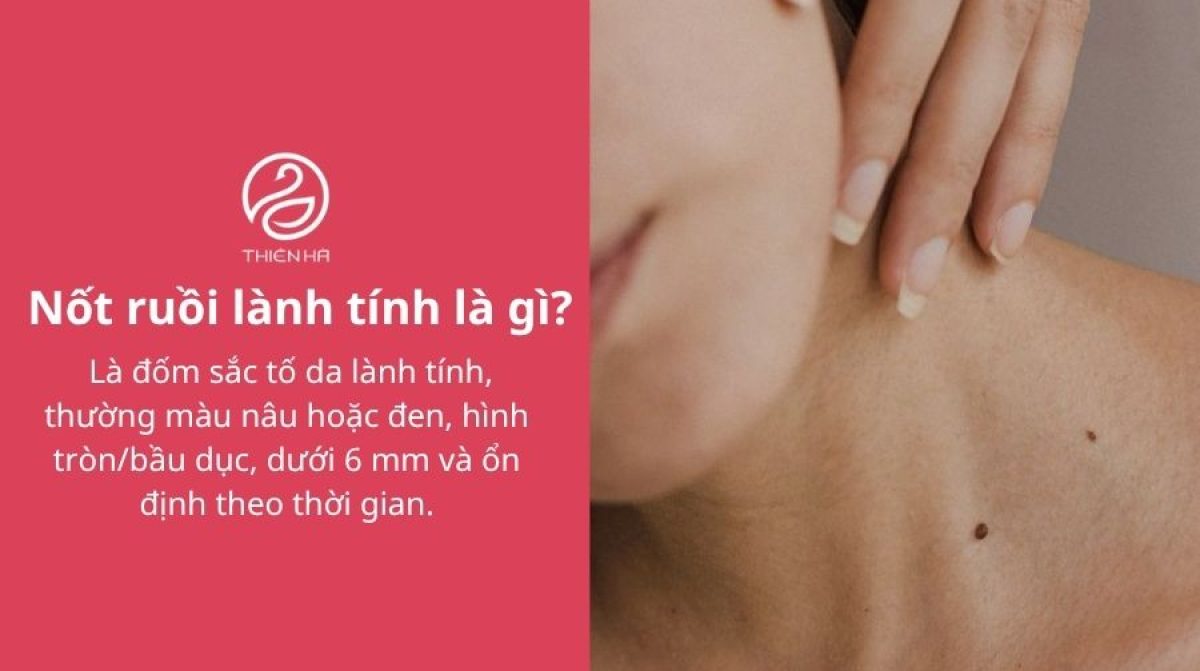 Nốt ruồi lành tính: Phân biệt với ác tính và cách xử lý đúng