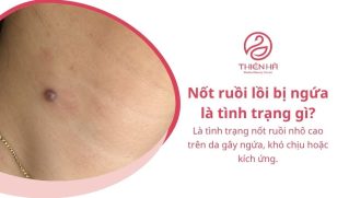 Nốt ruồi lồi bị ngứa: Nguyên nhân và cách xử lý an toàn