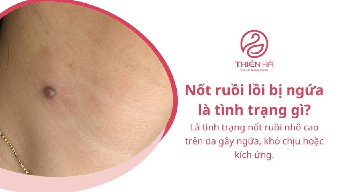Nốt ruồi lồi bị ngứa: Nguyên nhân và cách xử lý an toàn