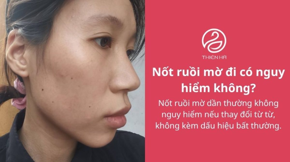 Nốt ruồi mờ đi: Có nguy hiểm không và khi nào cần kiểm tra?