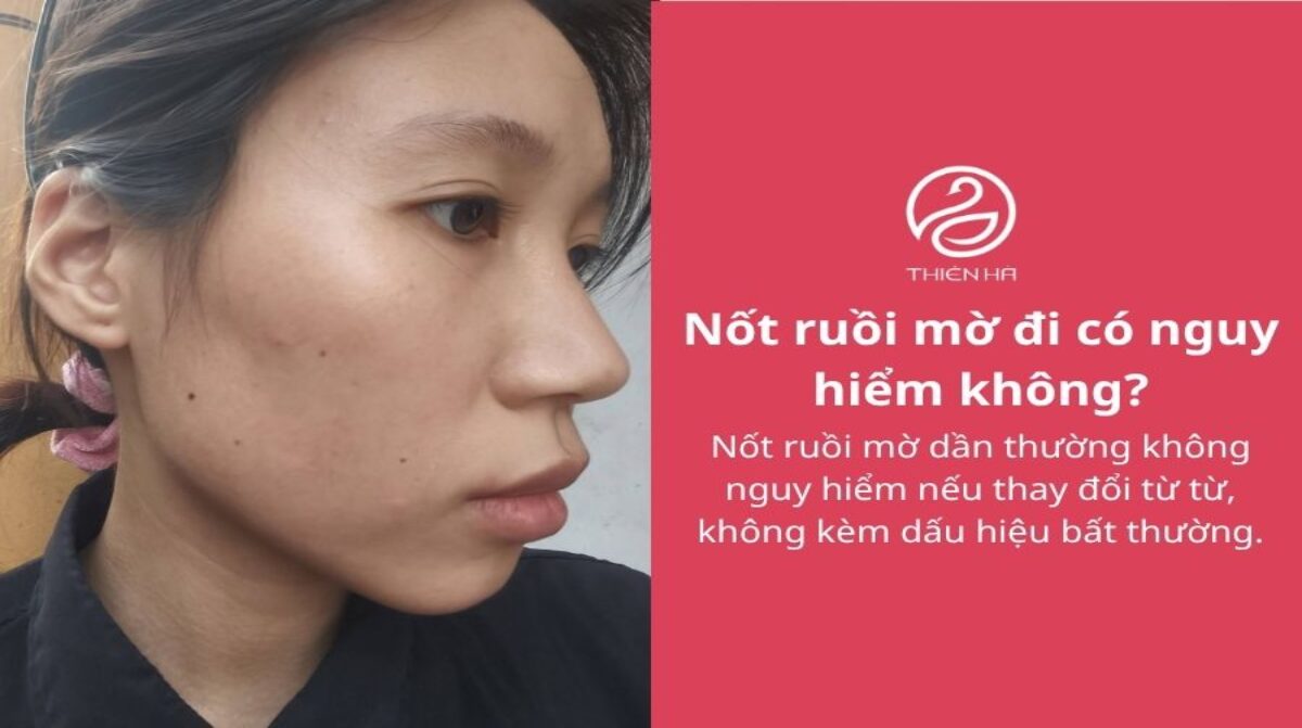 Nốt ruồi mờ đi: Có nguy hiểm không và khi nào cần kiểm tra?