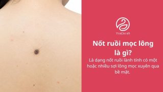 Nốt ruồi mọc lông: Nguyên nhân, mức độ nguy hiểm và cách xử lý