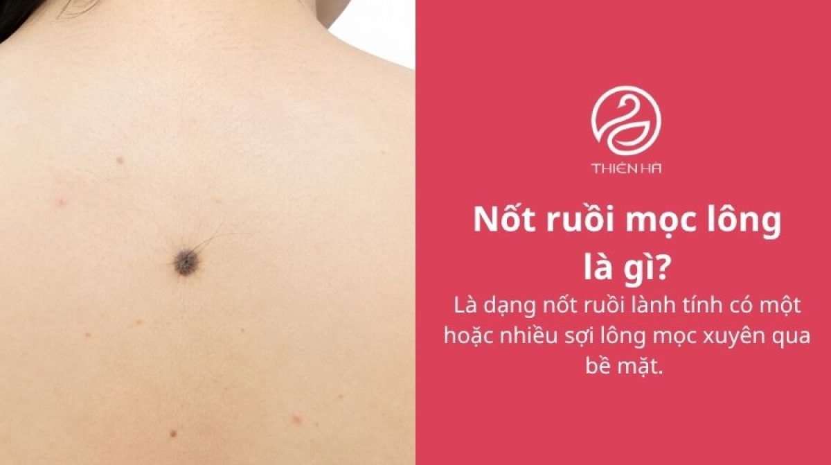 Nốt ruồi mọc lông: Nguyên nhân, mức độ nguy hiểm và cách xử lý