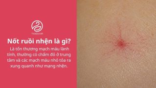 Nốt ruồi nhện có nguy hiểm không? Cách nhận biết và điều trị