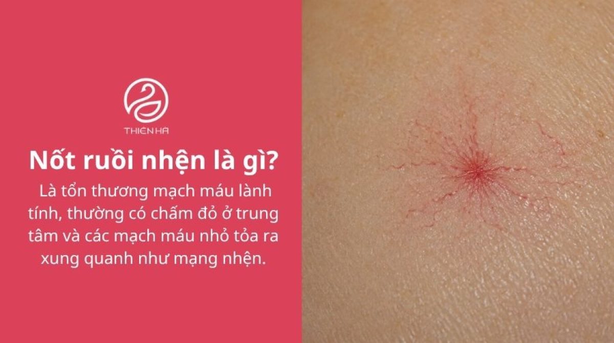 Nốt ruồi nhện có nguy hiểm không? Cách nhận biết và điều trị