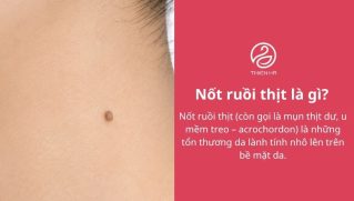 Nốt ruồi thịt là gì? Nguyên nhân, cách nhận biết và xử lý an toàn