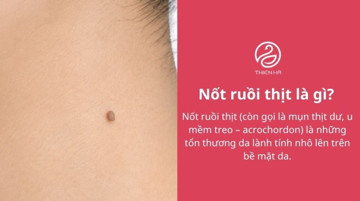 Nốt ruồi thịt là gì? Nguyên nhân, cách nhận biết và xử lý an toàn