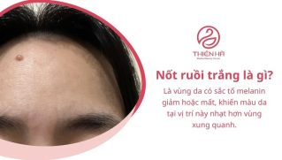 Nốt ruồi trắng: Nguyên nhân, mức độ nguy hiểm và cách xử lý
