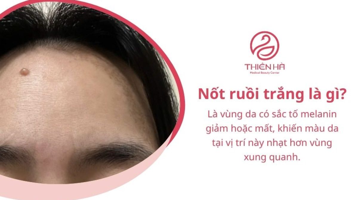Nốt ruồi trắng: Nguyên nhân, mức độ nguy hiểm và cách xử lý