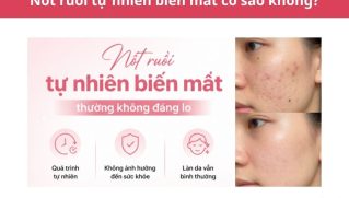 Nốt ruồi tự nhiên biến mất: Nguyên nhân và khi nào cần khám?