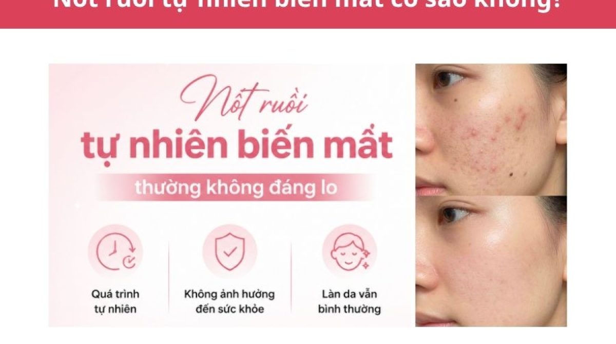 Nốt ruồi tự nhiên biến mất: Nguyên nhân và khi nào cần khám?