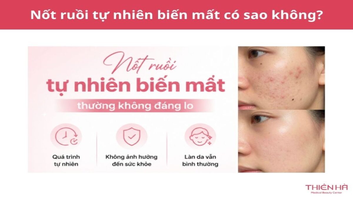 Nốt ruồi tự nhiên biến mất: Nguyên nhân và khi nào cần khám?
