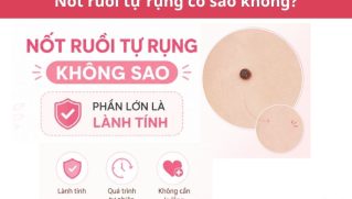 Nốt ruồi tự rụng có sao không? Cách nhận biết và xử lý an toàn