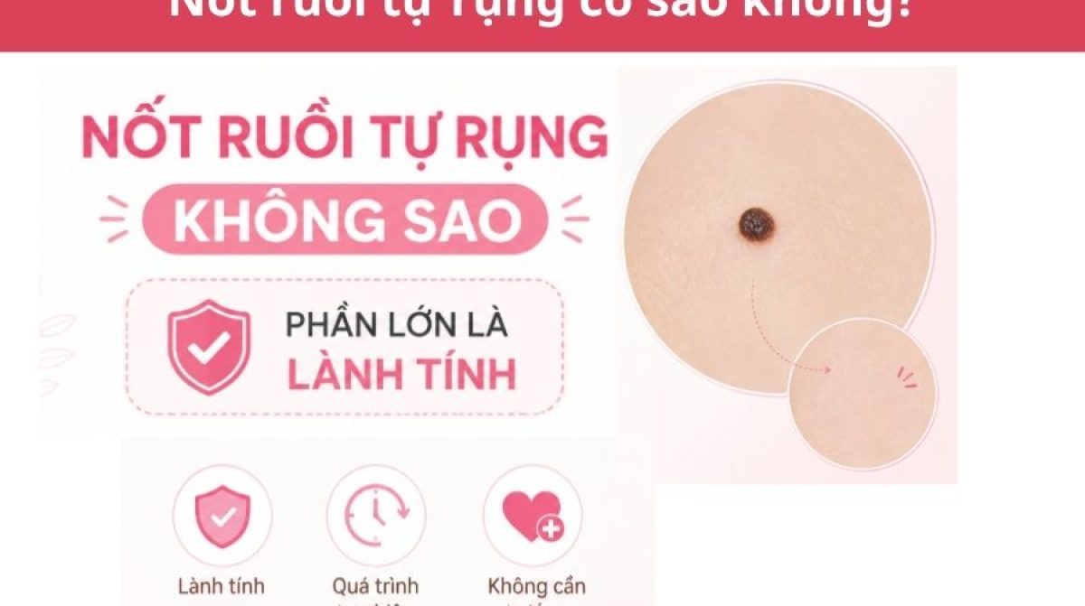 Nốt ruồi tự rụng có sao không? Cách nhận biết và xử lý an toàn