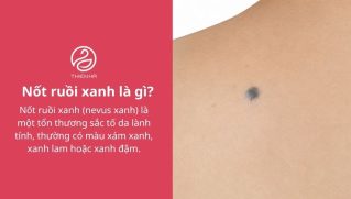 Nốt ruồi xanh có nguy hiểm không? Đặc điểm và cách xử lý phù hợp