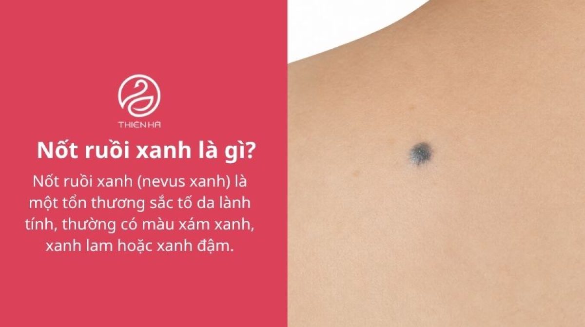 Nốt ruồi xanh có nguy hiểm không? Đặc điểm và cách xử lý phù hợp