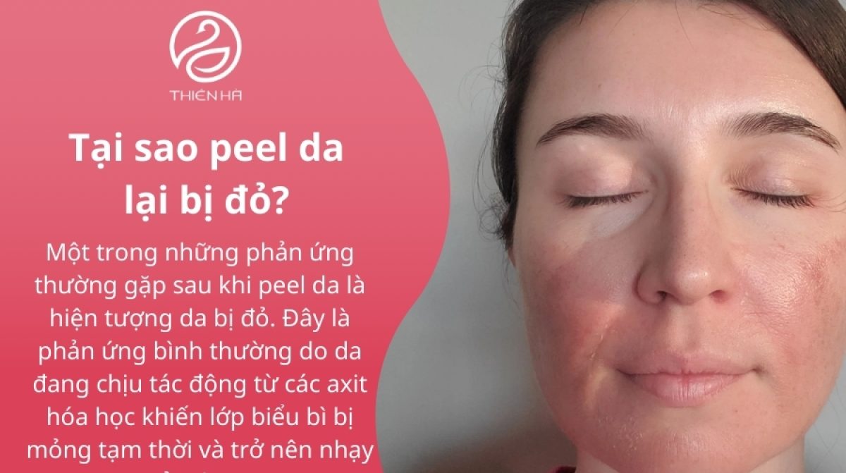 Peel da bị đỏ: Nguyên nhân, cách xử lý và khi nào cần gặp bác sĩ?