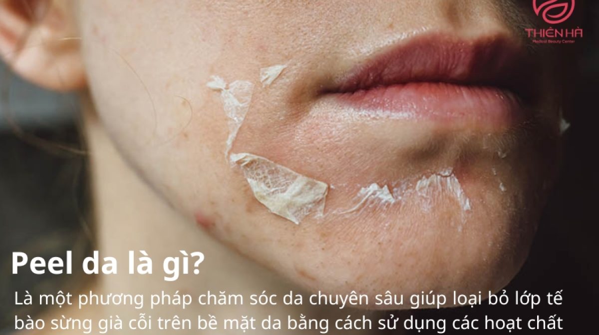 Peel da là gì? Lợi ích, quy trình và những điều cần lưu ý