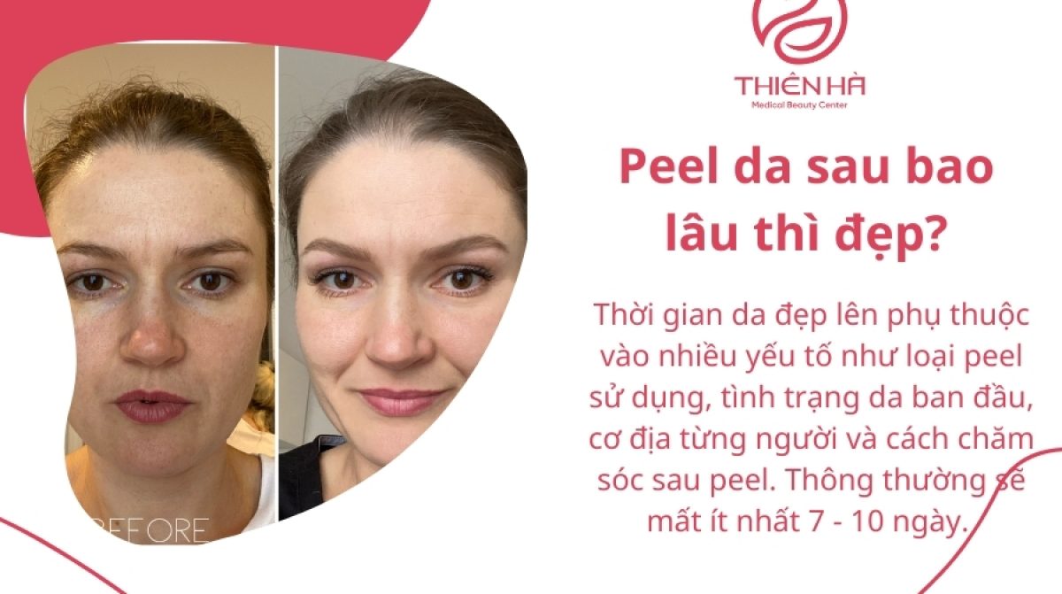 Peel da sau bao lâu thì đẹp? Quy trình & Lưu ý quan trọng