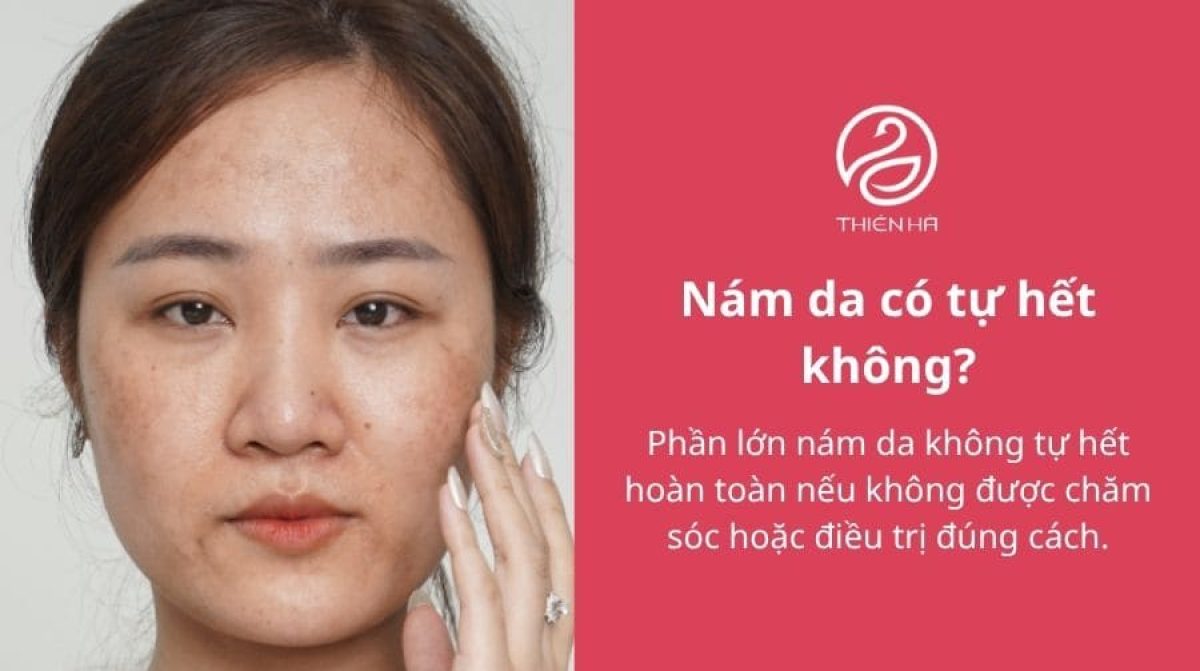 Phân biệt nám và tàn nhang: Điểm giống và khác nhau thế nào?