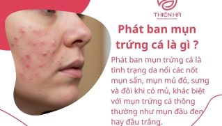 Nhận biết phát ban mụn trứng cá và phương pháp điều trị hiệu quả