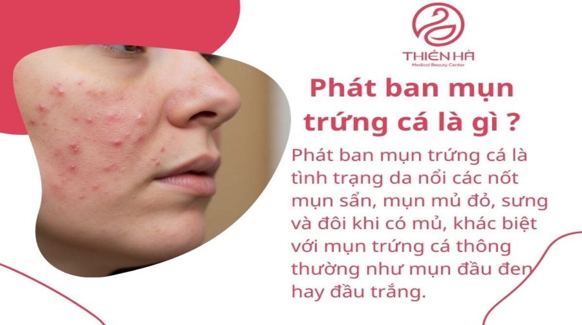 Nhận biết phát ban mụn trứng cá và phương pháp điều trị hiệu quả